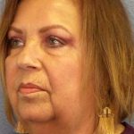 Facelift Before & After Patient #7570