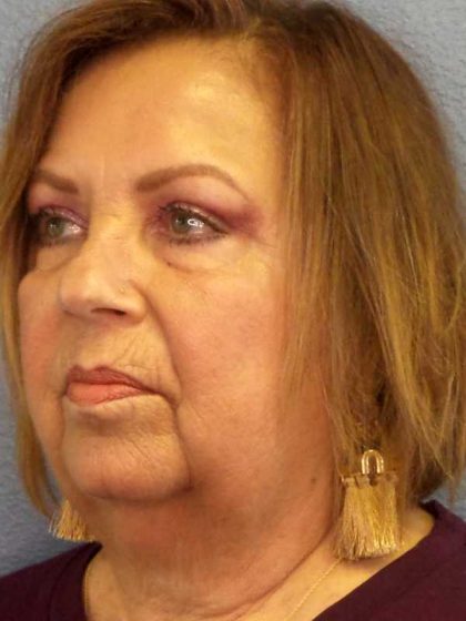 Facelift Before & After Patient #7570