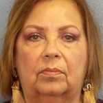 Facelift Before & After Patient #7570