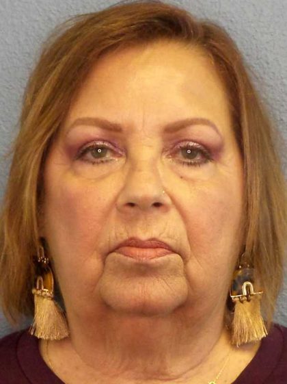 Facelift Before & After Patient #7570