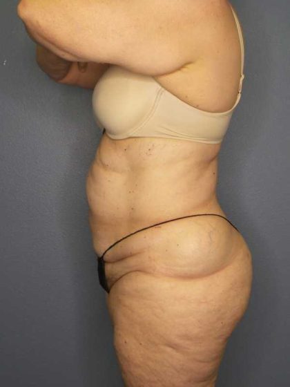 High BMI (Larger Patients) Surgery Before & After Patient #10444