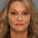 Facelift Before & After Patient #11903