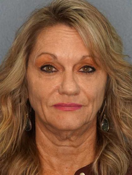 Facelift Before & After Patient #11903