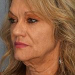 Facelift Before & After Patient #11903