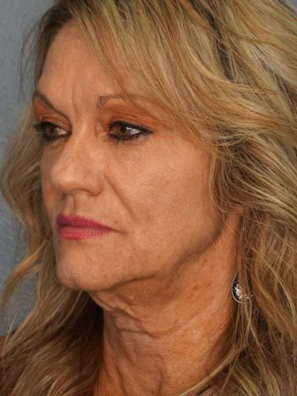 Facelift Before & After Patient #11903