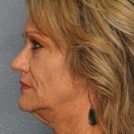Facelift Before & After Patient #11903