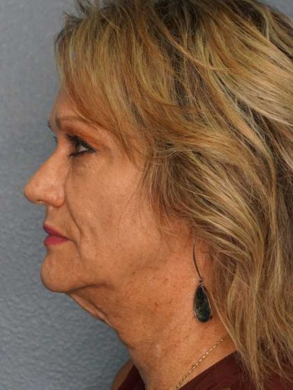 Facelift Before & After Patient #11903