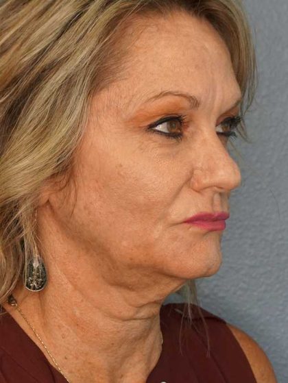 Facelift Before & After Patient #11903