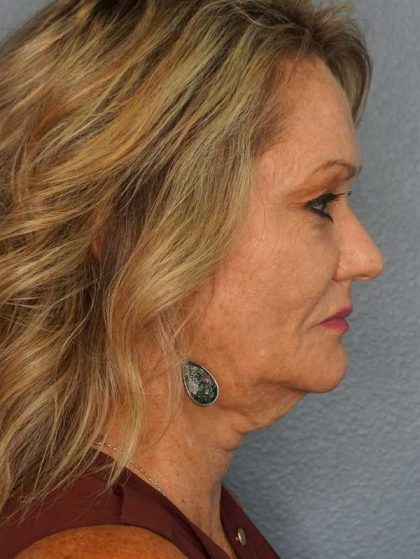 Facelift Before & After Patient #11903