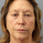 Facelift Before & After Patient #11694