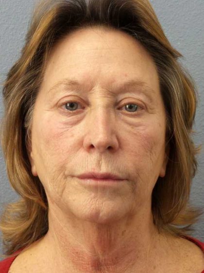 Facelift Before & After Patient #11694