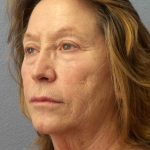 Facelift Before & After Patient #11694