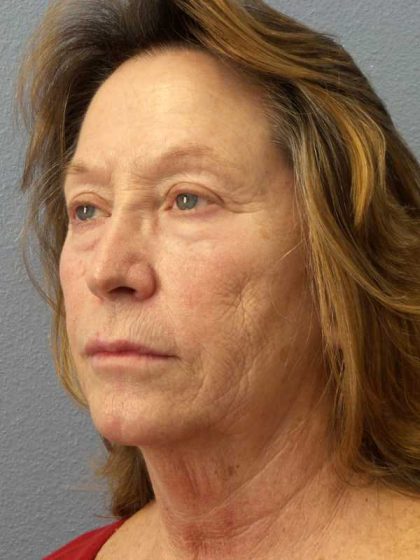 Facelift Before & After Patient #11694