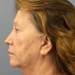 Facelift Before & After Patient #11694