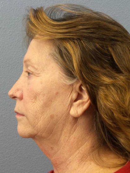 Facelift Before & After Patient #11694