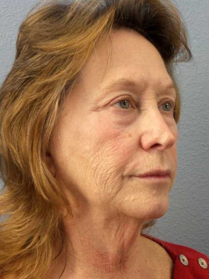 Facelift Before & After Patient #11694