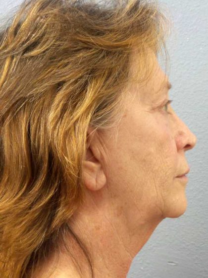 Facelift Before & After Patient #11694