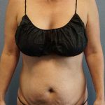 Abdominoplasty Before & After Patient #11086