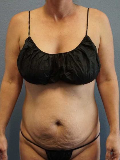 Abdominoplasty Before & After Patient #11086