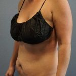 Abdominoplasty Before & After Patient #11086