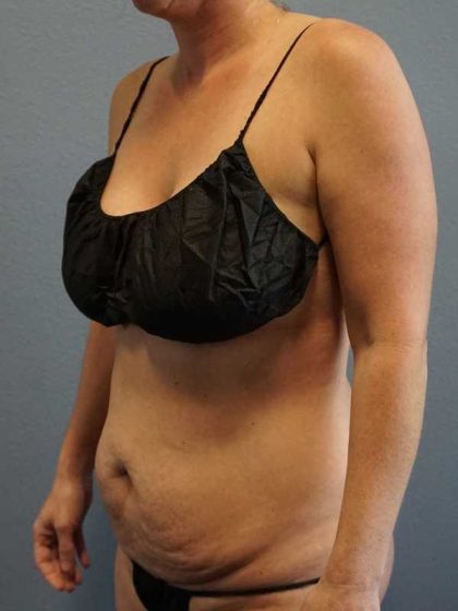Abdominoplasty Before & After Patient #11086