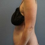 Abdominoplasty Before & After Patient #11086