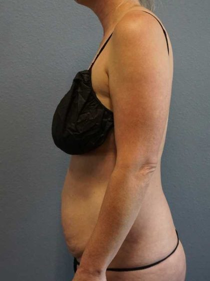 Abdominoplasty Before & After Patient #11086