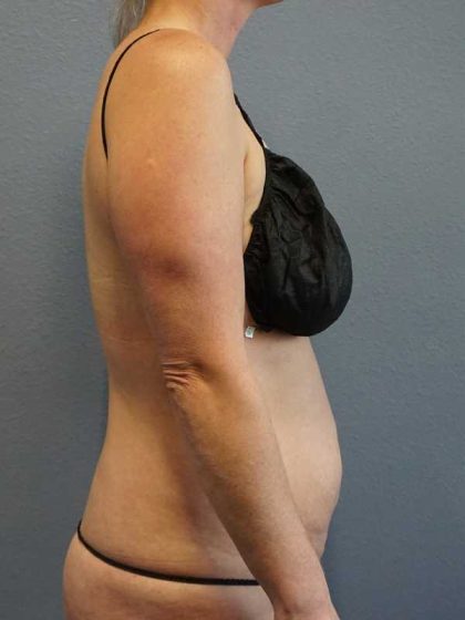 Abdominoplasty Before & After Patient #11086