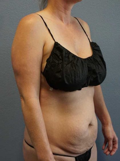 Abdominoplasty Before & After Patient #11086