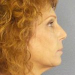 Facelift Before & After Patient #11725