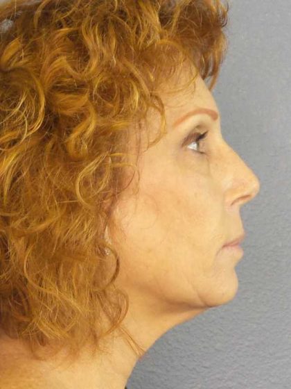 Facelift Before & After Patient #11725