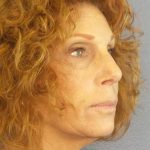 Facelift Before & After Patient #11725