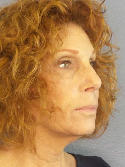 Facelift Before & After Patient #11725