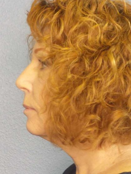 Facelift Before & After Patient #11725