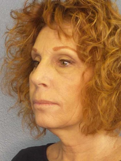 Facelift Before & After Patient #11725