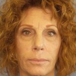 Facelift Before & After Patient #11725
