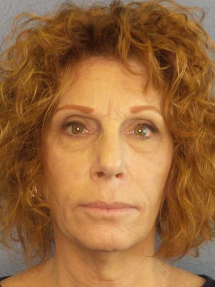 Facelift Before & After Patient #11725