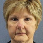 Facelift Before & After Patient #11640