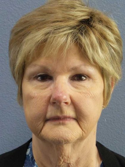 Facelift Before & After Patient #11640