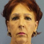 Facelift Before & After Patient #11714