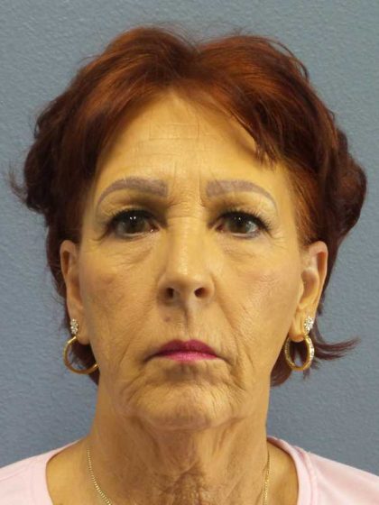Facelift Before & After Patient #11714
