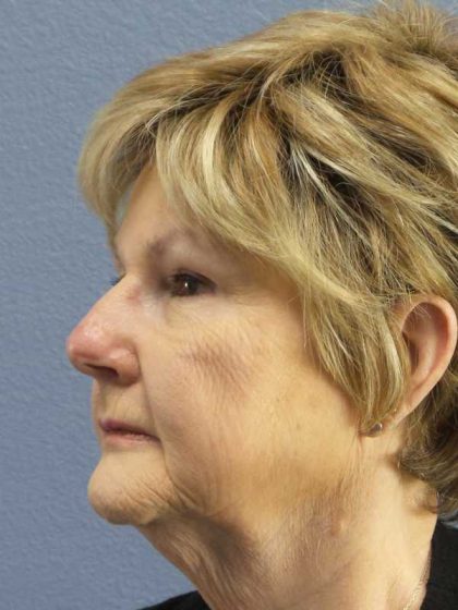 Facelift Before & After Patient #11640