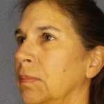 Facelift Before & After Patient #7557