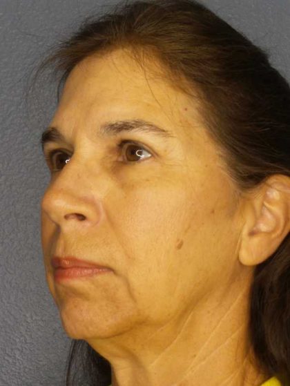 Facelift Before & After Patient #7557