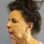 Facelift Before & After Patient #7514