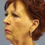 Facelift Before & After Patient #11714