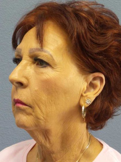 Facelift Before & After Patient #11714