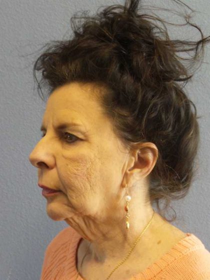 Facelift Before & After Patient #7514