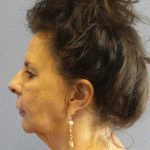 Facelift Before & After Patient #7514