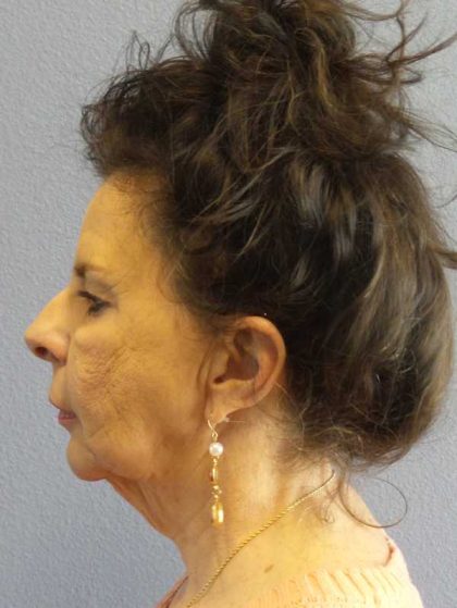 Facelift Before & After Patient #7514